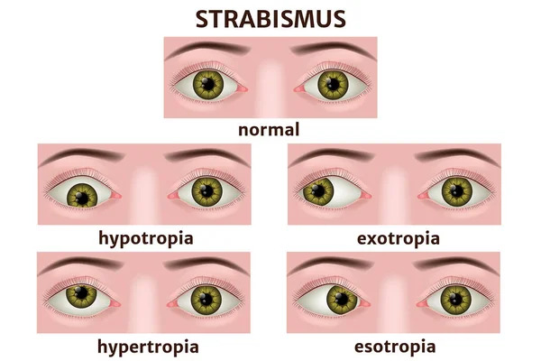 Variedades Estrabismo Infográfico Doenças Oculares Cartaz Médico Ilustração Vetorial —  Vetores de Stock