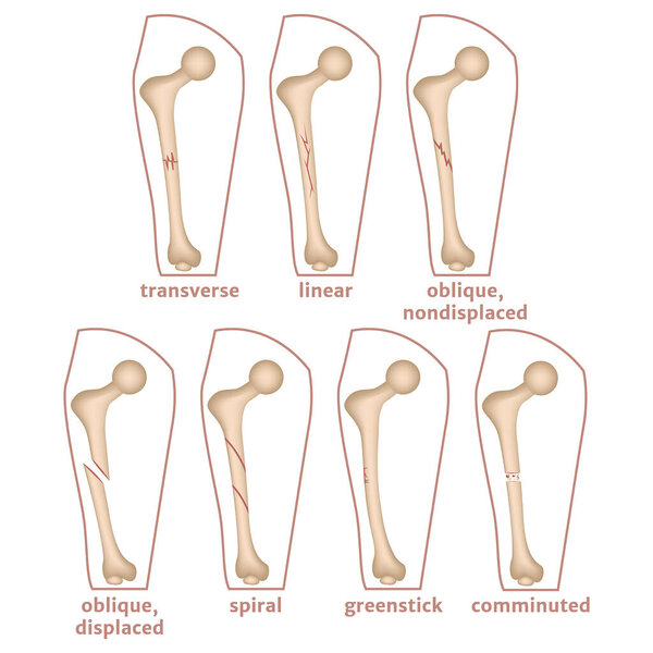 Инфографика с типами переломов бедренной кости. Медицинский плакат, векторная иллюстрация