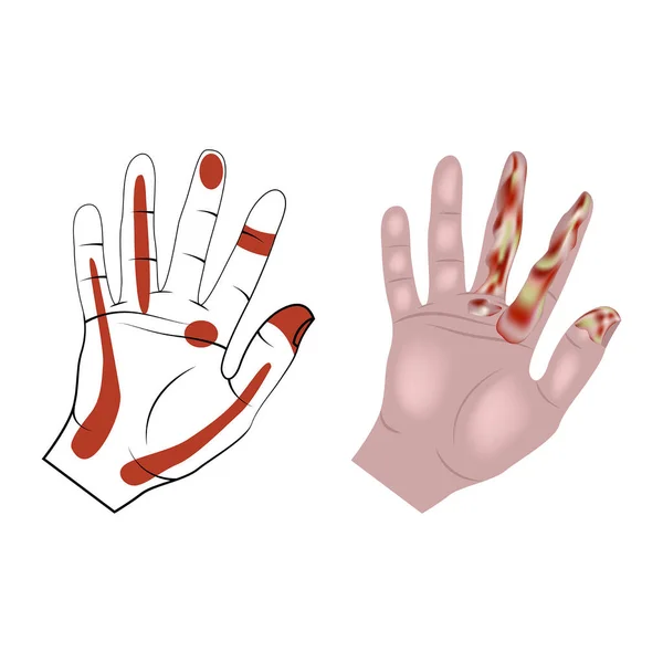 stock vector Pyoinflammatory processes of hands and fingers. Infographic with affected areas. Vector illustration