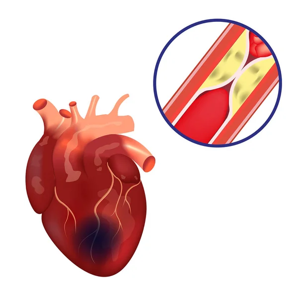 stock vector Coronary artery disease. Disease infographic. Atherosclerosis of the vessels. Medical vector illustration