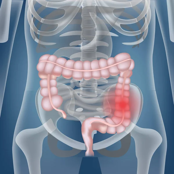 腸癌だ 骨格を背景にした内臓の位置 病気の徴候と腹部の空洞 — ストックベクタ