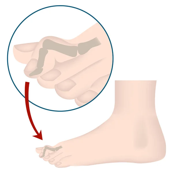 Деформация Пальцев Ног Молотком Медицинский Плакат Векторная Иллюстрация — стоковый вектор
