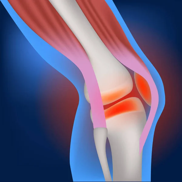 Inflammation Knäleden Och Miniscus Muskuloskeletala Systemet Vektor Illustration — Stock vektor