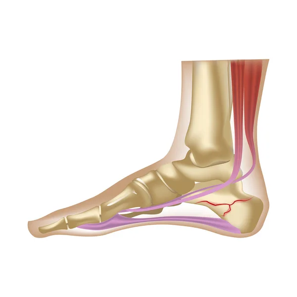 Kalkaneus Kırığı Nsan Ayağı Anatomisi Gerçekçi Bacak Çizimi Vektör Illüstrasyonu — Stok Vektör
