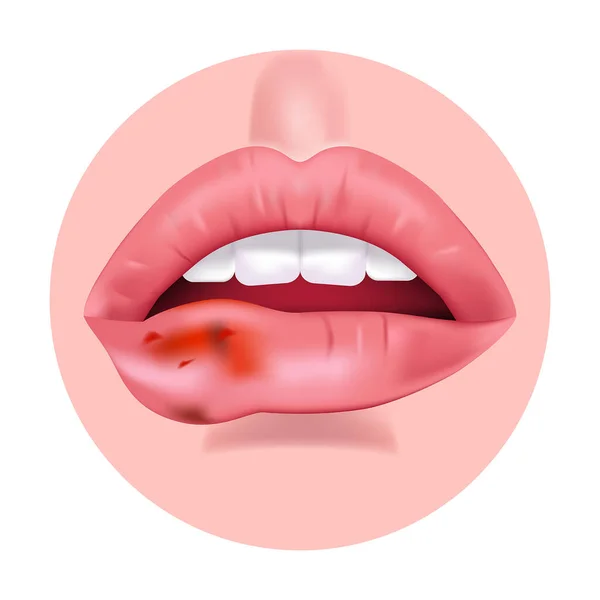 Рак Губ Пухлина Кров Відкрий Рот Векторні Ілюстрації — стоковий вектор