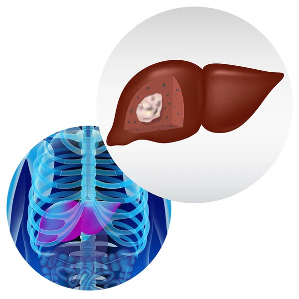 Rakovina Jater Nádor Sekci Nemoc Infografiky Realistické Ztvárnění Lidského Těla — Stockový vektor