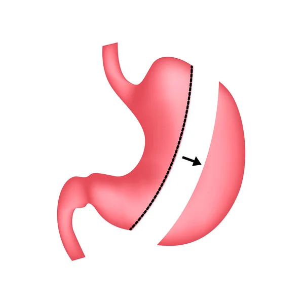 Resección Longitudinal Del Estómago Tratamiento Obesidad Con Cirugía Ilustración Vectorial — Vector de stock