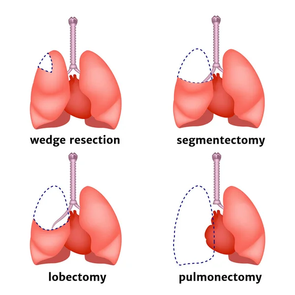 Tipos Ressecção Pulmonar Remoção Órgão Suas Partes Individuais Caso Câncer —  Vetores de Stock