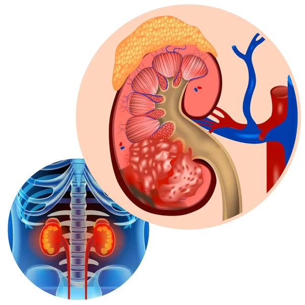 Böbrek Kanseri Tümör Bölümünde Hastalık Bilgi Grafikleri Nsan Vücudunun Organlarının — Stok Vektör