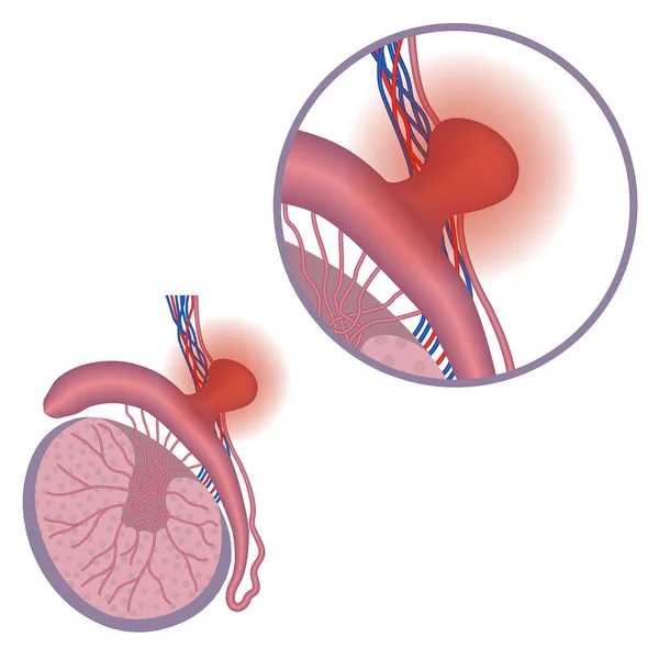 Spermatocele Cisto Epididimal Anatomia Sistema Reprodutor Masculino Cartaz Médico Ilustração —  Vetores de Stock