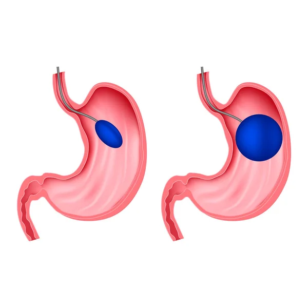 Montáž Břišního Balónu Postup Hubnutí Anatomie Zažívacích Orgánů Lékařský Plakát — Stockový vektor