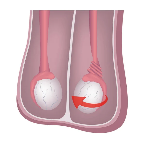 Torsion Testiculaire Diagramme Avec Anatomie Des Organes Génitaux Masculins Affiche — Image vectorielle