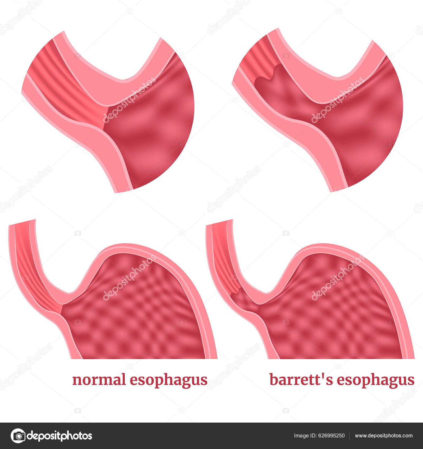 Barrett's Esophagus Diagram Stomach Disease Medical Poster Vector