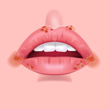 rash on lips, herpes. Pimples and ulcers on the face. Open mouth with teeth. Vector illustration clipart