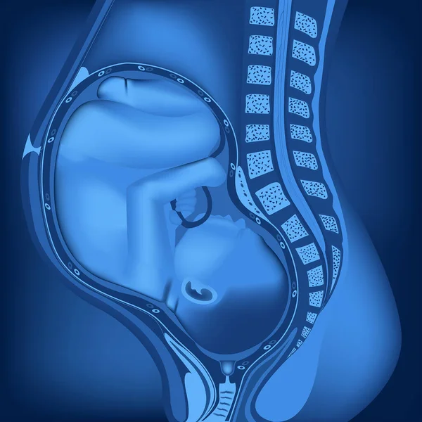 縦断面の妊婦の体 子宮の中の赤ん坊 青ネオンイラスト 医療ポスター ベクターイラスト — ストックベクタ