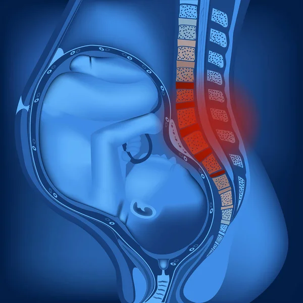 怀孕期间脊椎和后背疼痛 子宫里的婴儿 女性解剖学的霓虹灯渲染 蓝色背景的广告 矢量说明 — 图库矢量图片