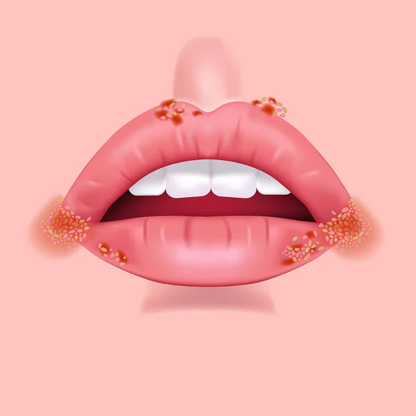 Висип Губах Герпес Прищі Виразки Обличчі Відкрийте Рот Зубами Векторні — стоковий вектор
