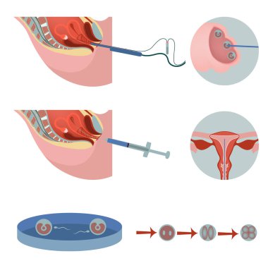 yapay döllenme. Kadın üreme organları tüp bebek prosedürü ile ilgili bilgi ve diyagram. Tıbbi poster. Vektör illüstrasyonu