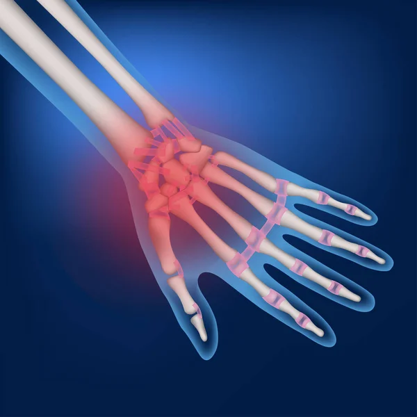 Emberi Kéz Csontjai Kék Háttérrel Ízületek Gyulladása Orvosi Poszter Vektorillusztráció — Stock Vector