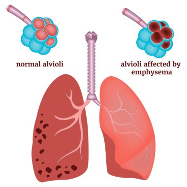 Amfizemi olan bir bilgi. Normal ve hasarlı bronz. Tıbbi poster, Vektör çizimi.