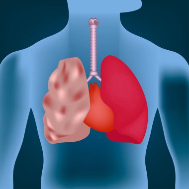 Ciğerlerde amfizem var. Neon illüstrasyon. Gövdenin arka planında organlar var. Vektör illüstrasyonu
