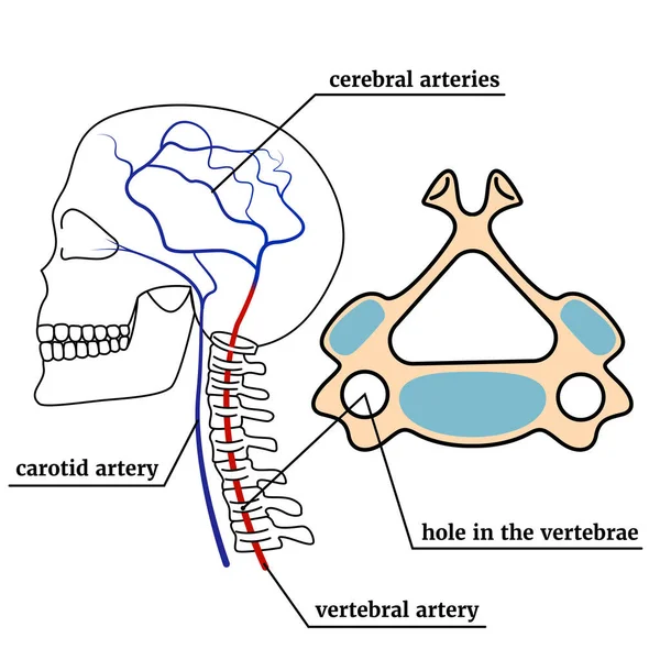 Kontur Tengkorak Dengan Tulang Belakang Infografis Dengan Sindrom Arteri Vertebral - Stok Vektor