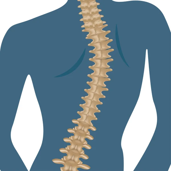 人間の脊椎の変形性関節症 湾曲した背中を持つ女性のシルエット ベクターイラスト — ストックベクタ