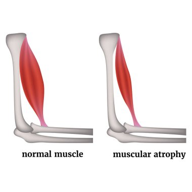 Infographic with arm muscle atrophy. Medical poster. Vector illustration clipart