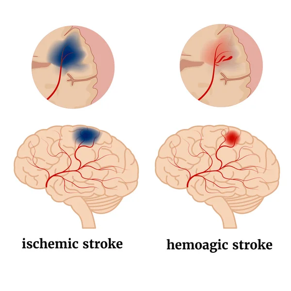 Infográficos Com Tipos Acidente Vascular Cerebral Cartaz Médico Ilustração Vetorial —  Vetores de Stock