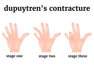 Dupuytren's contracture. 3 stages of development of the disease. Injury to the tendons of the hand, palm. Medical poster with description, vector illustration clipart