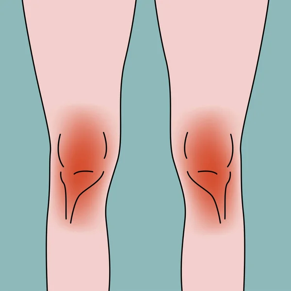 Sakit Lutut Latar Belakang Medis Ilustrasi Rata Vektor - Stok Vektor