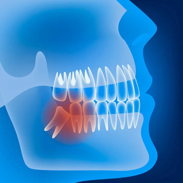 歯の成長が正しくない ライト プロファイル 医療ポスター ベクトル図 — ストックベクタ