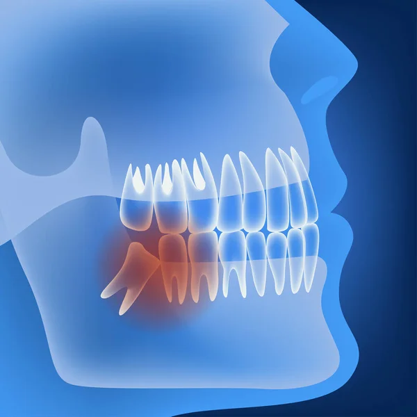 Nieprawidłowy Wzrost Zębów Mądrości Profil Światła Plakat Medyczny Ilustracja Ilustracja Stockowa