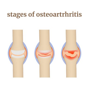 Osteoartrosis aşamaları, eklemlerin tahrip edilmesi ve kıkırdak hastalığı. Tıbbi bilgiler, posterler. Vektör illüstrasyonu