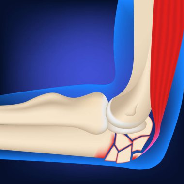 Dirsek ekleminde parçalanmış kırık var. Mavi arka planda 3D görüntüleme. Medina vektör illüstrasyonu