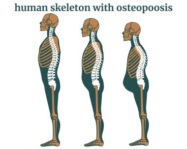 Osteoporoz nedeniyle insan omurgasının tahrip edilmesi. Düşük yükseklik, vücut deformasyonu. Yaşla ilgili duruş değişiklikleri. Tıbbi poster, vektör illüstrasyonu