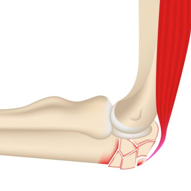 Dirsek ekleminde parçalanmış kırık var. Koldaki kemik ve kasların 3 boyutlu çizimi. Tıbbi poster, vektör illüstrasyonu