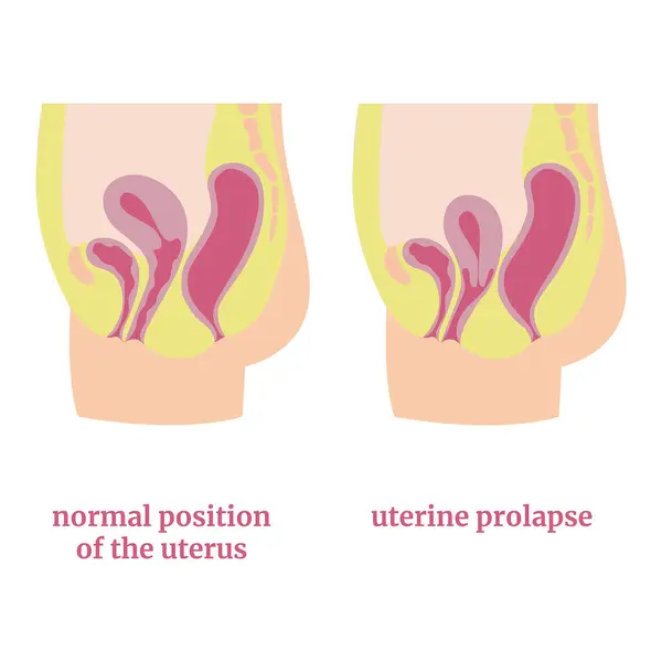 stock vector Uterine prolapse, diagram. Medical poster. Vector illustration