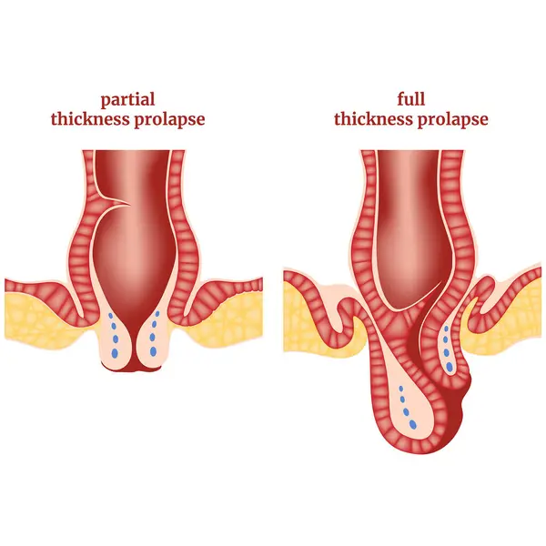 stock vector Anal prolapse, hemorrhoids. Diagram, scheme with the disease. Medical poster. Vector illustration