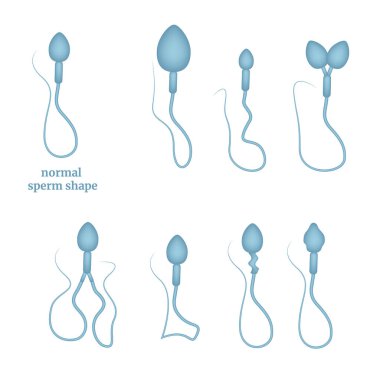 Sperm patolojisi türleri. Tıbbi bilgi grafikleri. Vektör