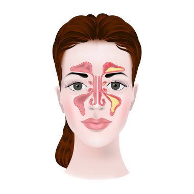 Sinüzit. Tıbbi diyagramı olan bir kadının yüzündeki üst çene sinüslerinin görüntüsü. Vektör illüstrasyonu