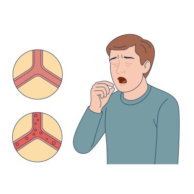 Bronşit diyagramı ve hastası olan bir tıbbi poster. Adam öksürüyor. Hastalık bilgileri var. Tıbbi vektör illüstrasyonu