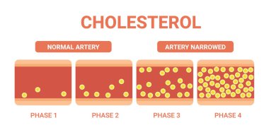 Atardamarda kolesterol, sağlık riski, vektör tasarımı