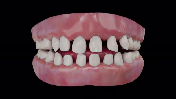 Animacja Prawdziwe Aparat Ortodontyczny Ruch Normalnie Pozować Alfa Matowe — Wideo stockowe