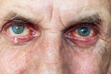 Gözlerinde yaş olan bir yetişkinin hasta gözleri.