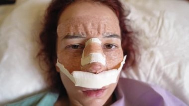 Rhinoplasti ameliyatından sonra Genç Kadın Hastane Odasında Yatıyor. Burnunda alçı olan bir kızın portresi. Plastik Cerrahi Konsepti. Yavaş Hareket.
