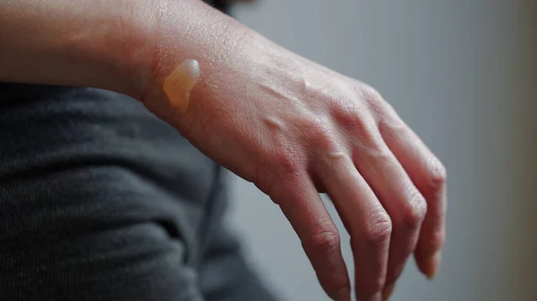 沸騰した水の燃焼 損傷した皮膚 1度または2度の燃焼からブリスターと女性の手のクローズアップ 痛い傷だ 熱燃焼だ 創傷治療からの水膀胱 マクロ写真 — ストック写真