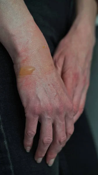 Крупный План Женской Руки Волдырем Кипящего Ожога Воды Поврежденной Кожей — стоковое фото