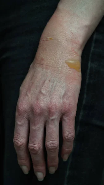 Крупный План Женской Руки Волдырем Кипящего Ожога Воды Поврежденной Кожей — стоковое фото