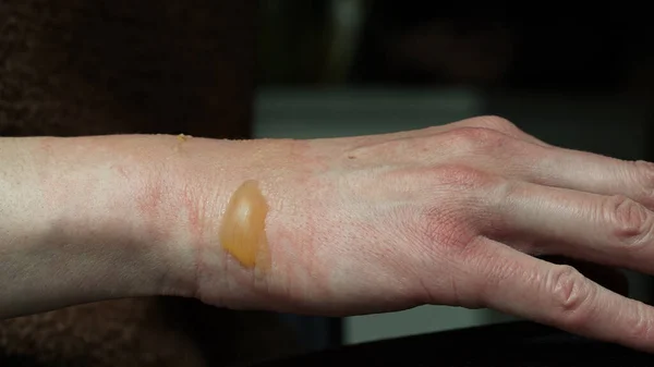 Close Woman Hand Blister Boiled Water Burn Damaged Skin 1St — Stock Photo, Image